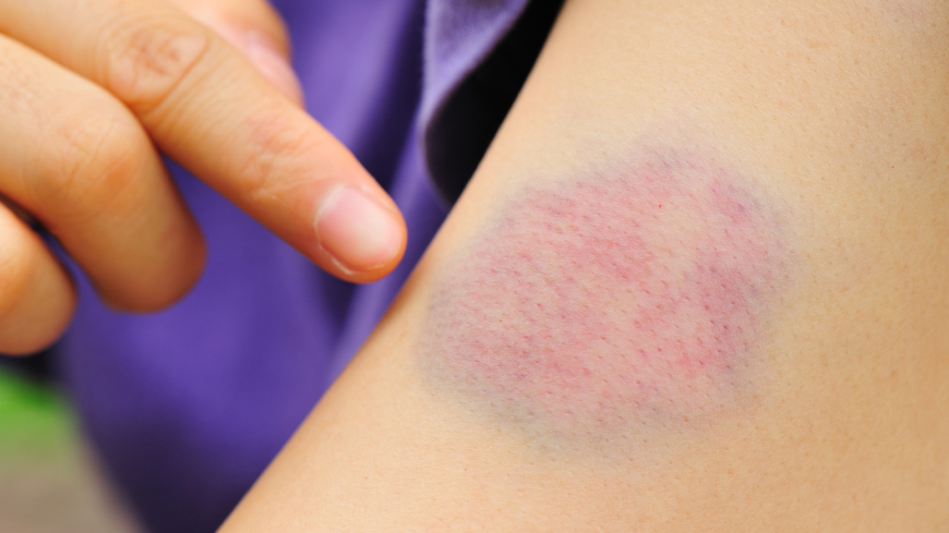 Vid leukemi får man ofta oförklarliga stora blåmärken på huden. Foto: Shutterstock